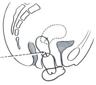 cervical prolapse symptoms