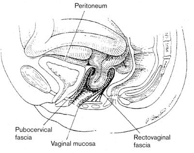 Vaginal vault prolapse